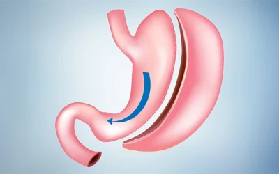 Gastric-Sleeve-Surgery