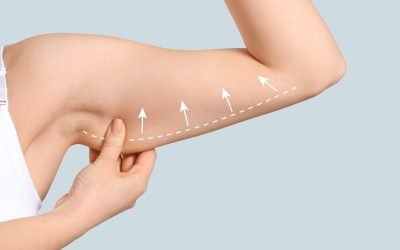 Arm of young woman after slimming on light background. Plastic surgery concept
