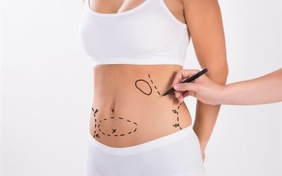 liposuction-68548-62647_b